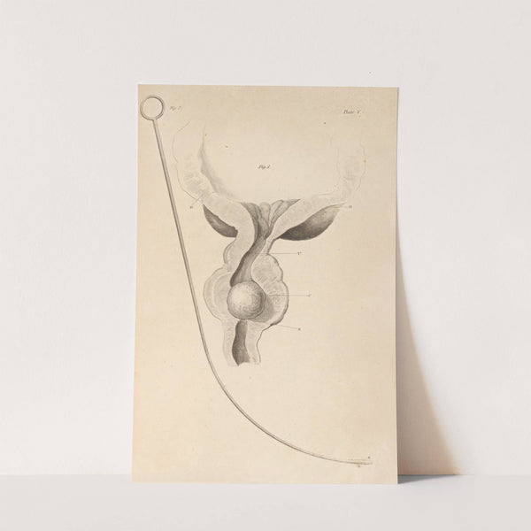 An Essay on the Chemical History and Medical Treatment of Calculous Disorders Pl.2 by Alexander Marcet