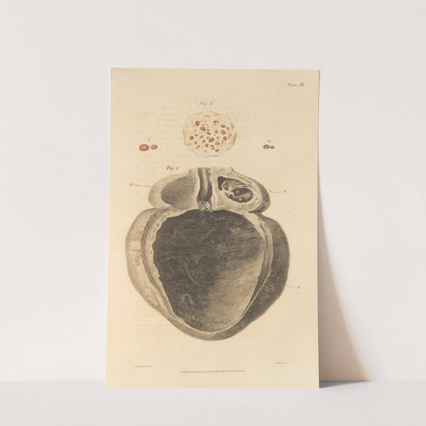 An Essay on the Chemical History and Medical Treatment of Calculous Disorders Pl.6 by Alexander Marcet