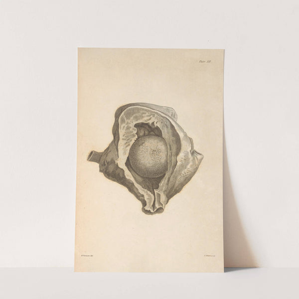 An Essay on the Chemical History and Medical Treatment of Calculous Disorders Pl.9 by Alexander Marcet