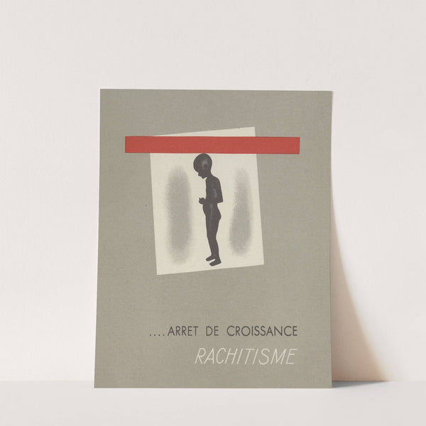 Arrêt de croissance ; rachitisme (1910-1950)