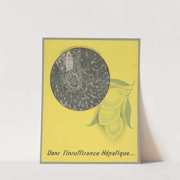 Dans l’insuffisance hépatique (1910-1950)