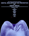Dental sealants in the prevention of tooth decay