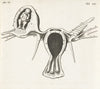 Anatomical image of an ectopic pregnancy. (1672)