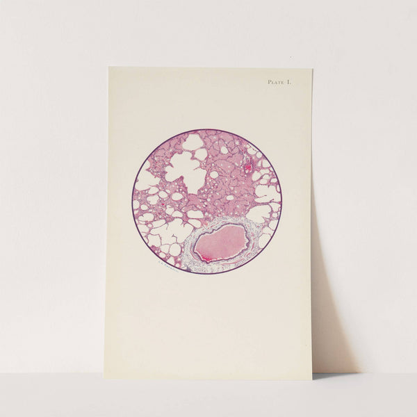 Plate I. Microscopic section of human lung from phosgene shell poisoning. Death at the nineteenth hour after gassing by A. Kirkpatrick Maxwell