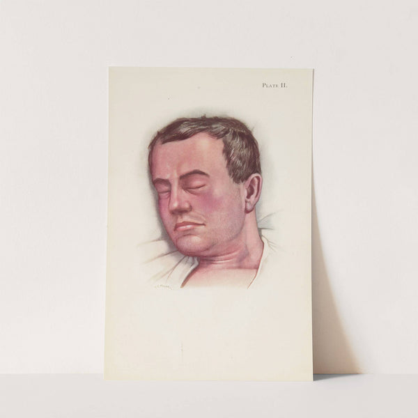 Plate II. Blue type of asphyxia from phosgene poisoning, with intense venous congestion by A. Kirkpatrick Maxwell