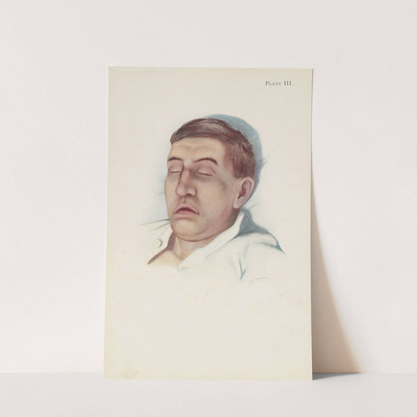 Plate III. Pallid type of asphyxia from phosgene poisoning, with circulatory failure by A. Kirkpatrick Maxwell