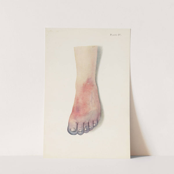 Plate IV. Gangrene of foot caused by vascular thrombosis from chlorine poisoning by A. Kirkpatrick Maxwell
