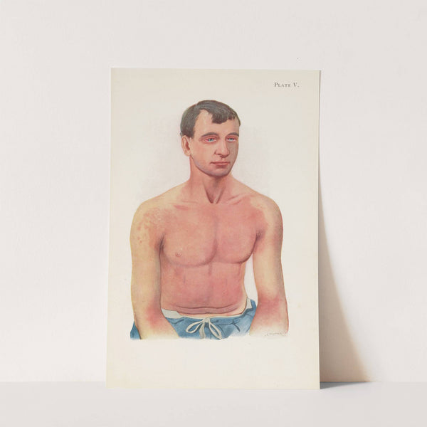 Plate V. Erythema of skin from general exposure to the vapour of Yellow Cross substance by A. Kirkpatrick Maxwell