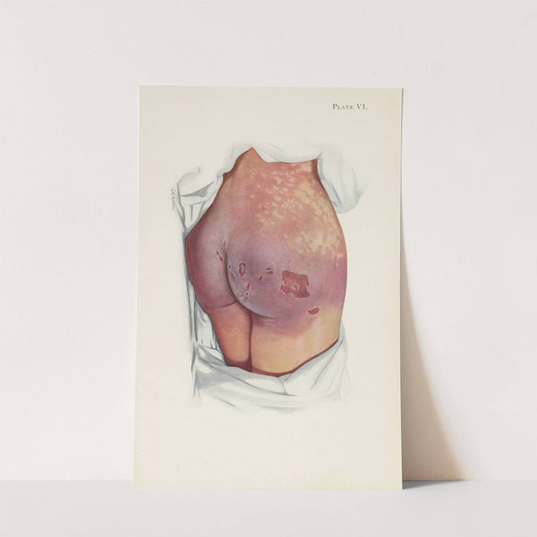 Plate VI. Blistering of buttocks by mustard gas by A. Kirkpatrick Maxwell