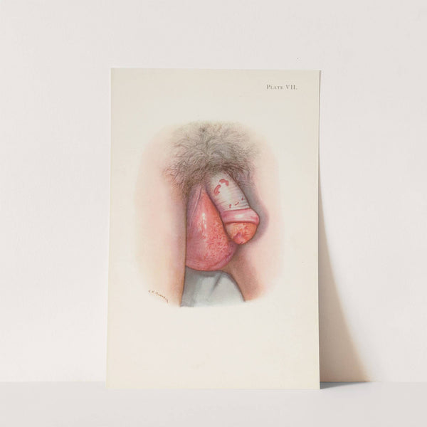 Plate VII. Burning of scrotum and penis by mustard gas by A. Kirkpatrick Maxwell