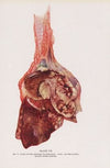 Plate VII (Fig. 3): Lungs of dog exposed to phosgene.