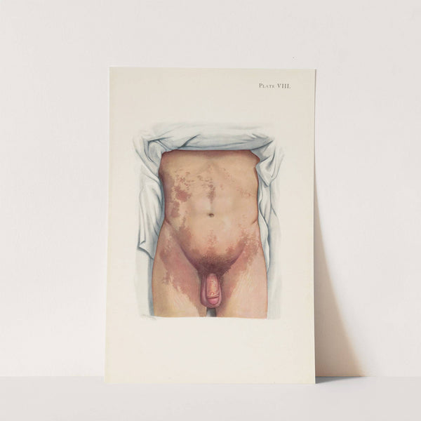 Plate VIII. Brown staining from mustard gas by A. Kirkpatrick Maxwell