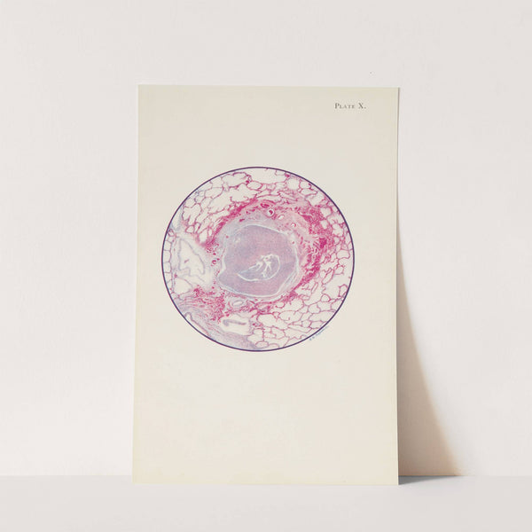 Plate X. Microscopic section of human lung from mustard gas poisoning, with death at end of second day (40 hours) by A. Kirkpatrick Maxwell