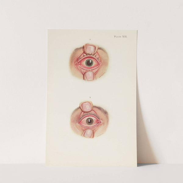 Plate XII. A. Stage of resolution after severe burning. B. Late stage of resolution by A. Kirkpatrick Maxwell