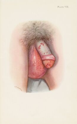 Plate VII. Burning of scrotum and penis by mustard gas