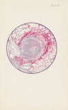 Plate X. Microscopic section of human lung from mustard gas poisoning, with death at end of second day (40 hours)
