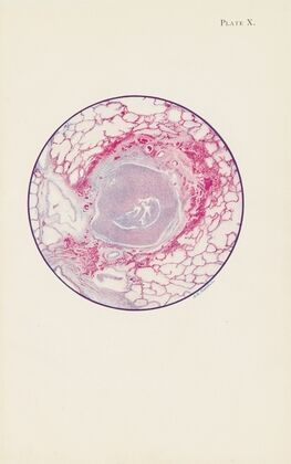 Plate X. Microscopic section of human lung from mustard gas poisoning, with death at end of second day (40 hours)