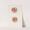 Plate XI. A. Severely burned eye in the acute stage. B. Slightly later stage of acute burning by A. Kirkpatrick Maxwell