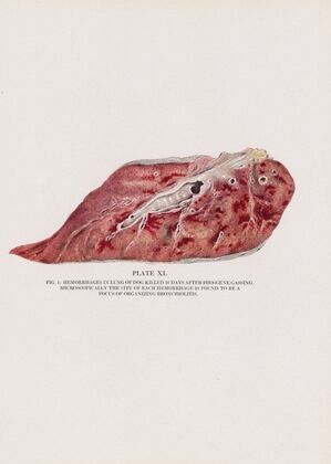Plate XL (Fig. 1): Hemorrhages in lung of dog killed 10 days after phosgene gassing.