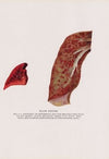 Plate XXXVIII (Figs. 8, 9): Congestion and hemorrhage about the bronchial tree standing out sharply against relatively normal lung tissue.